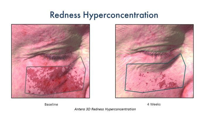 CerumWORX Results Redness