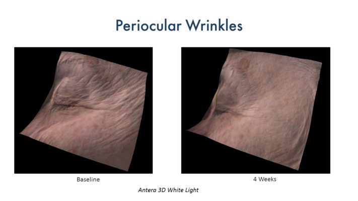 CerumWORX Results Wrinkles